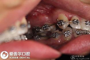 成人蛀牙真实案例视频大全,牙齿健康警示录