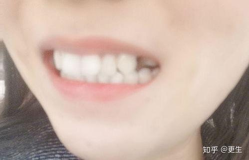 成人整牙拔牙过程视频,视频解析与专业解读