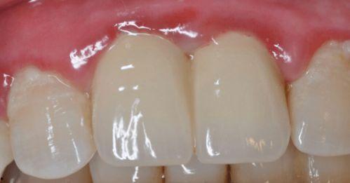 成人牙龈边缘发白视频,揭秘成人口腔健康隐患