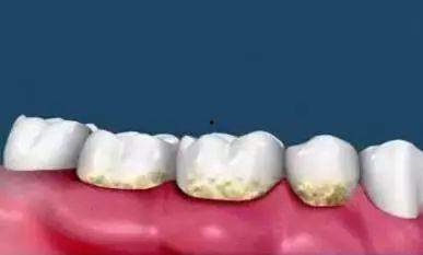 成人牙龈边缘发白视频,揭秘成人口腔健康隐患