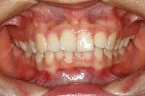 成人牙龈边缘发白视频,揭秘成人口腔健康隐患